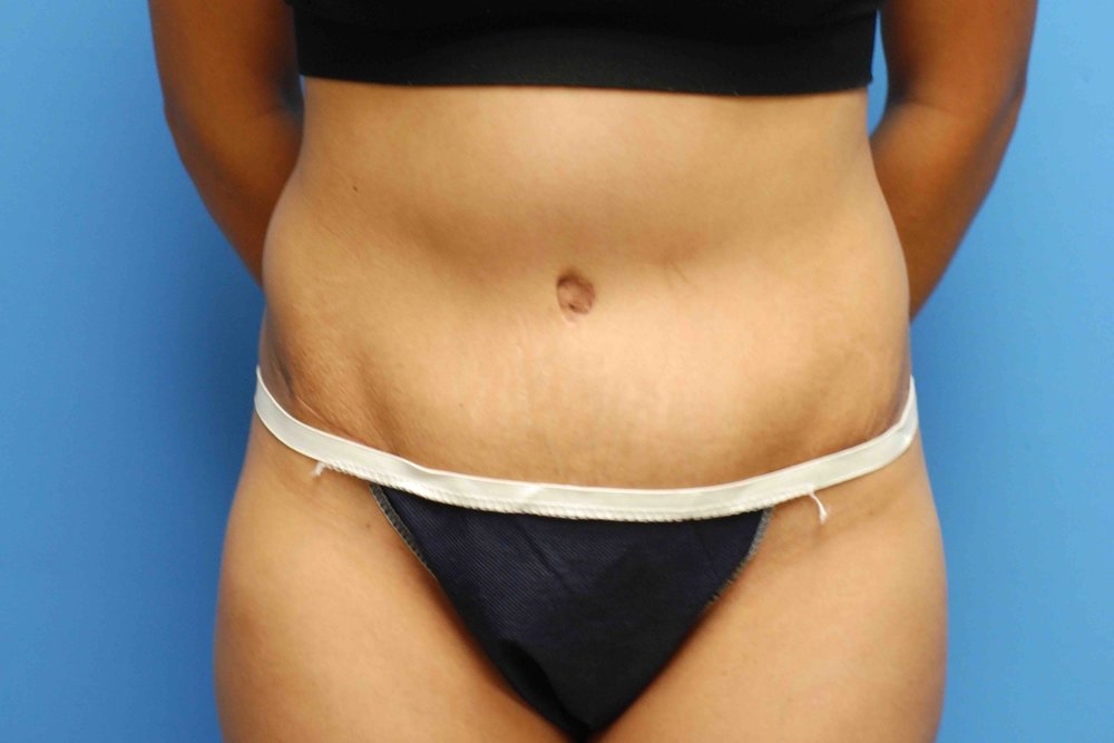Tummy Tuck after