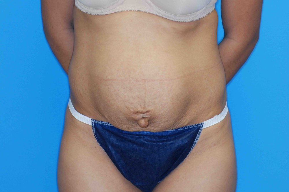 Tummy Tuck before