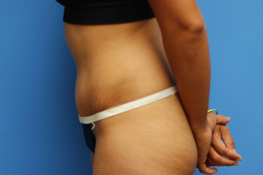 Tummy Tuck after