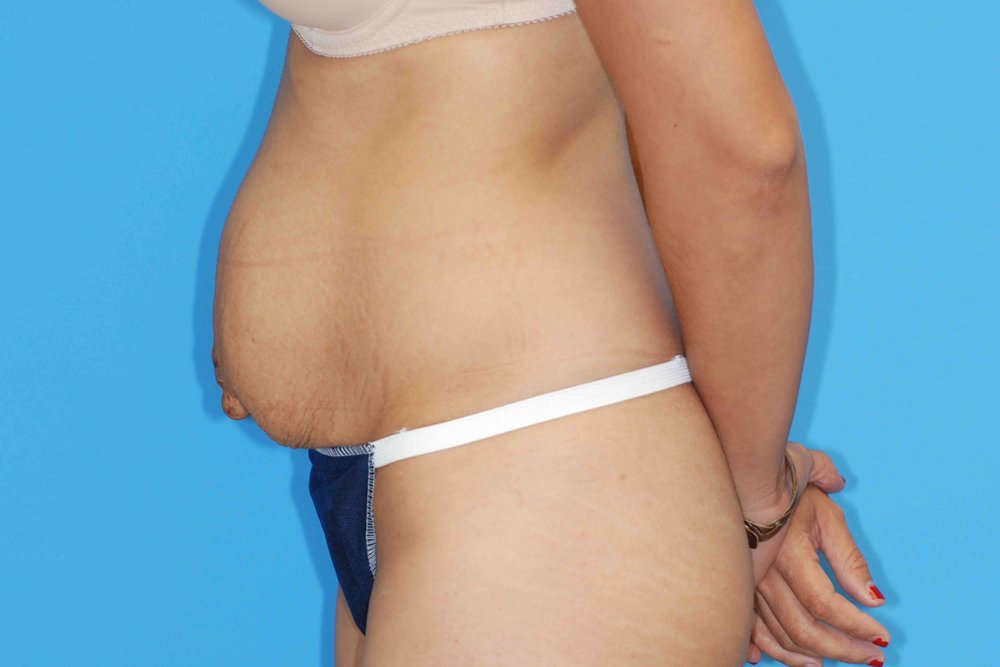 Tummy Tuck before