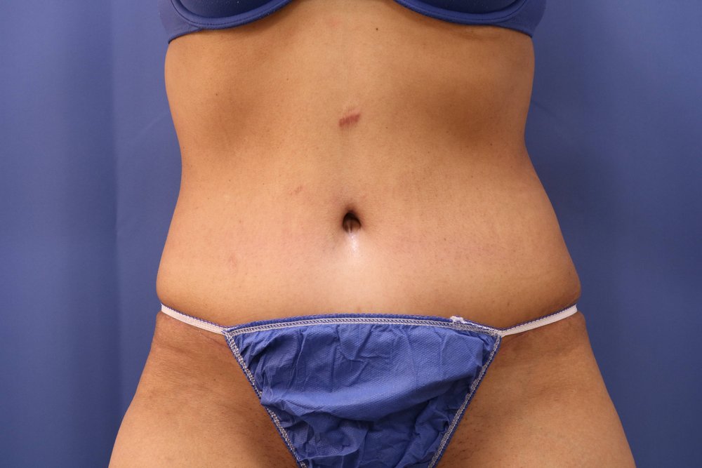 Tummy Tuck after