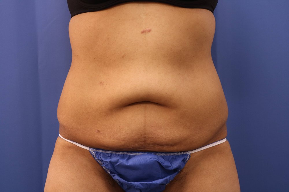 Tummy Tuck before