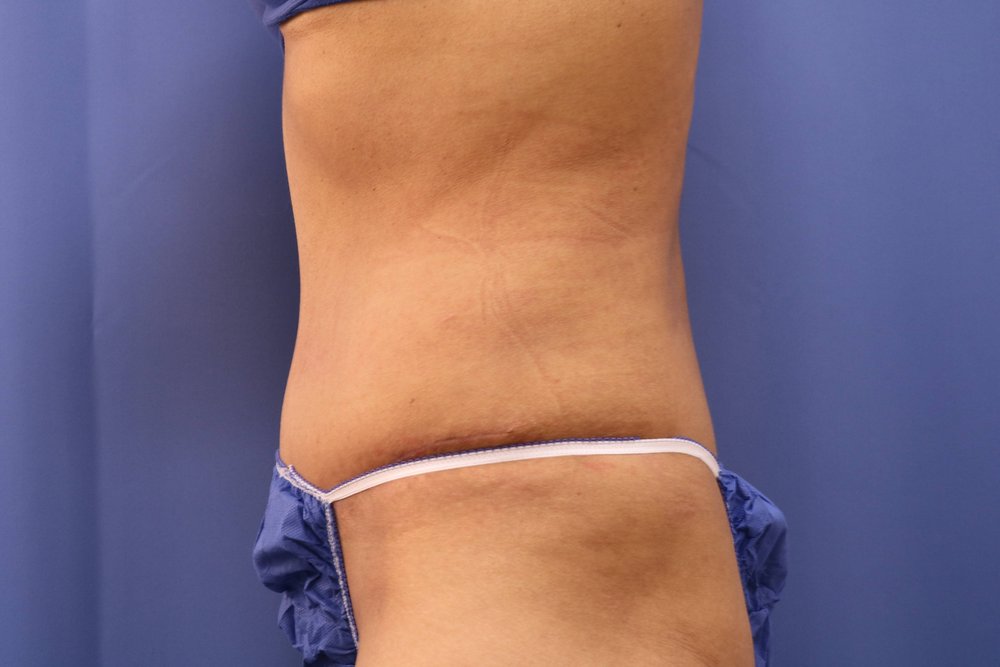 Tummy Tuck after