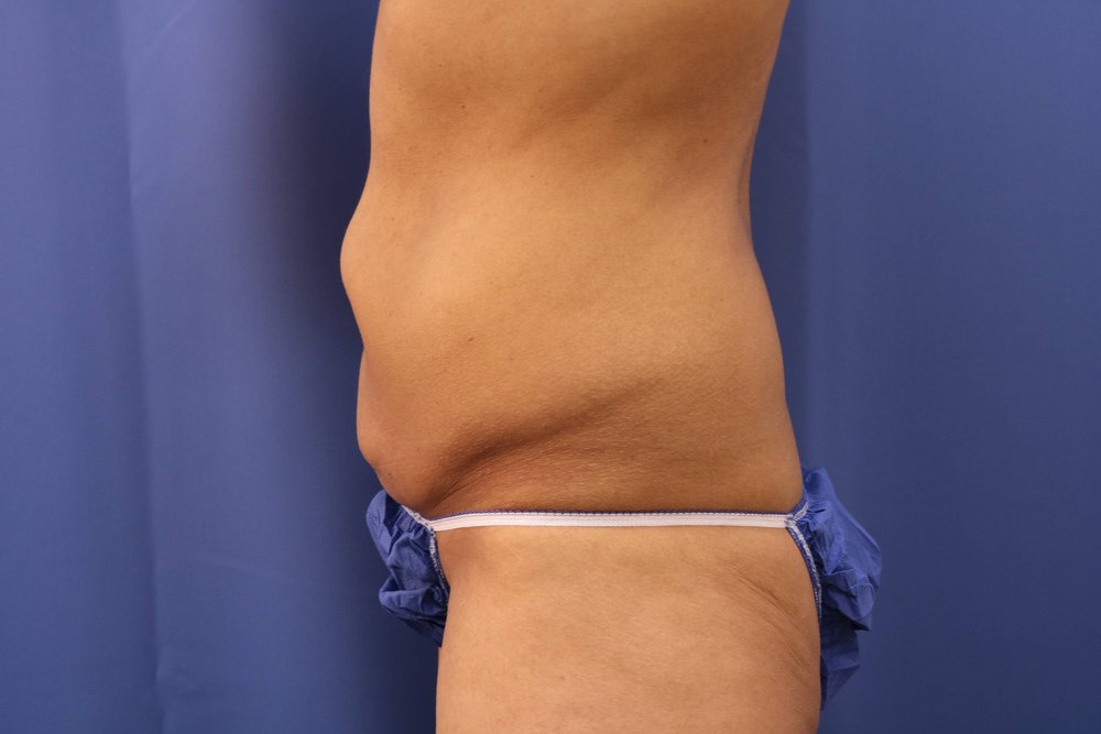 Tummy Tuck before