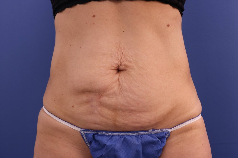 Tummy Tuck before