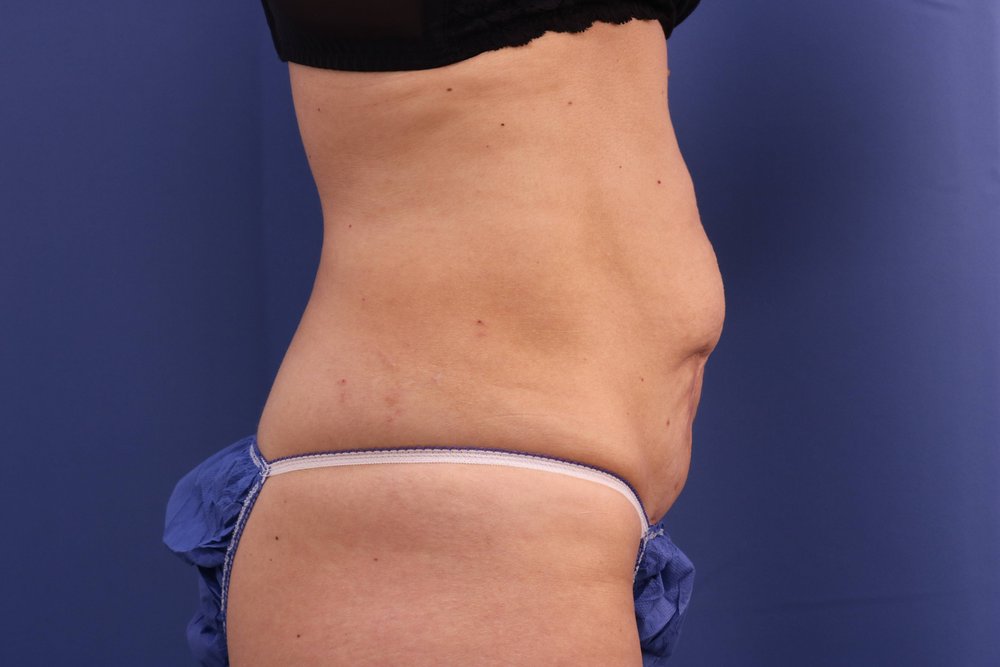 Tummy Tuck before