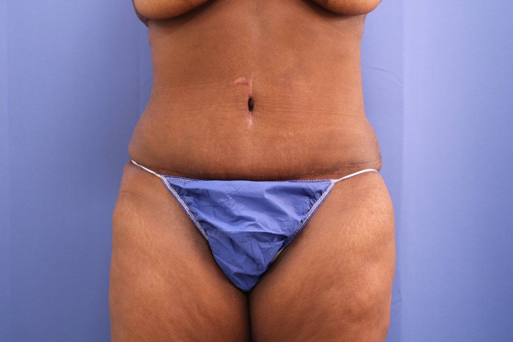 Tummy Tuck after