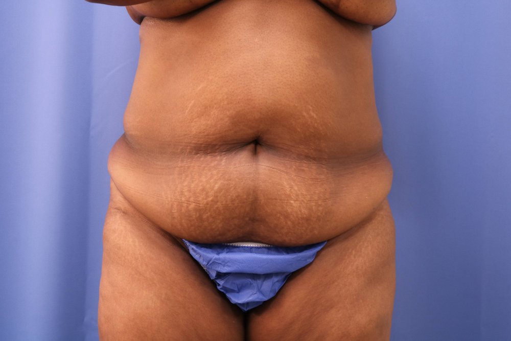 Tummy Tuck before
