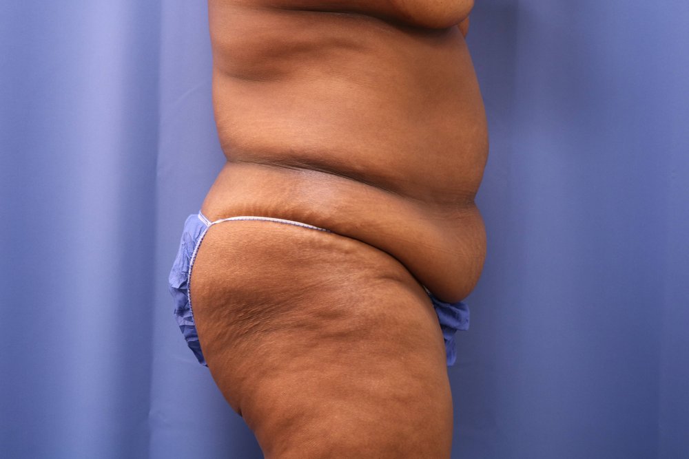 Tummy Tuck before