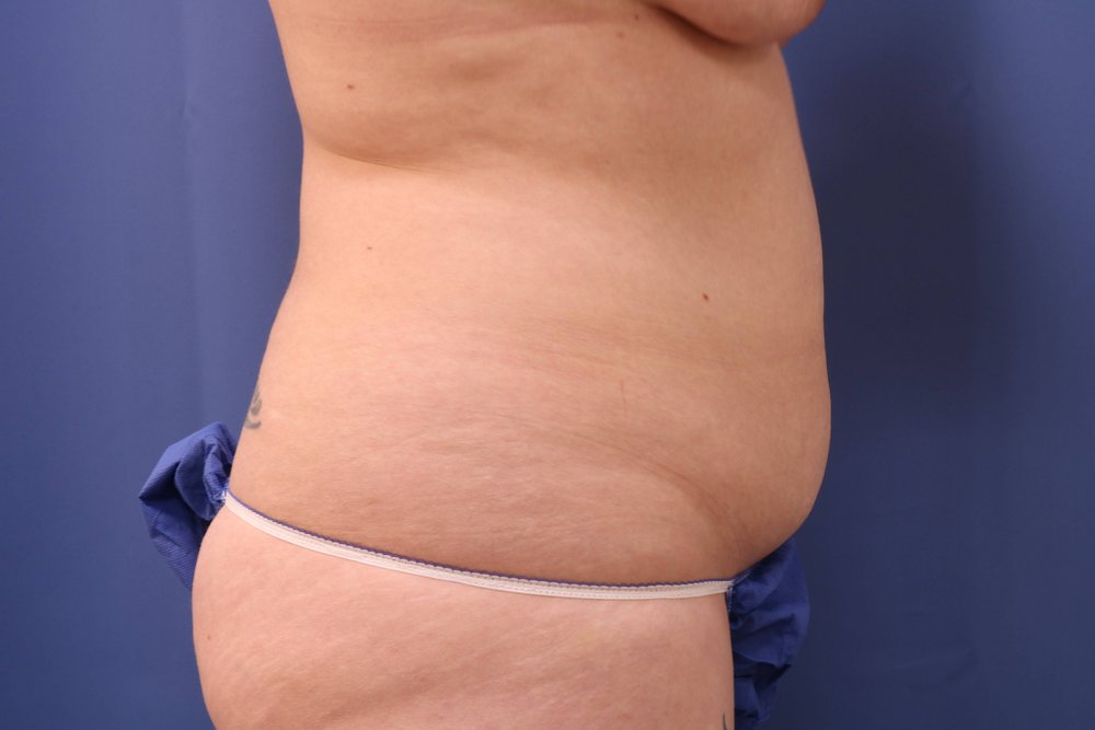 Tummy Tuck before
