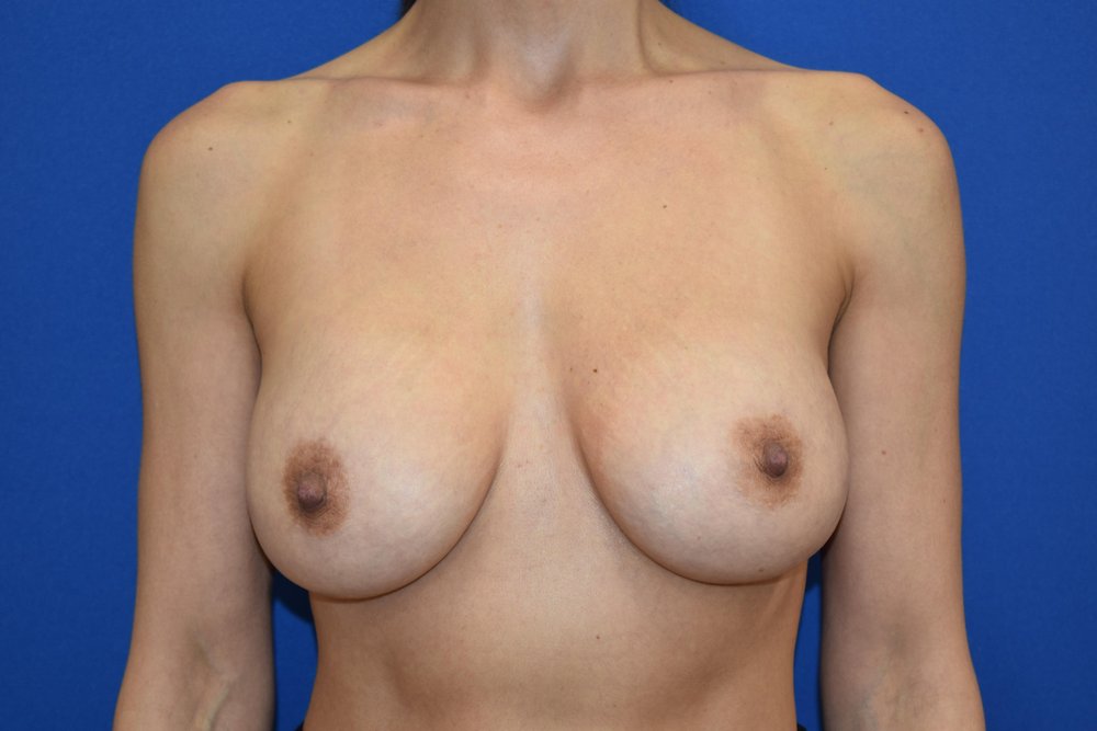 Breast Augmentation after