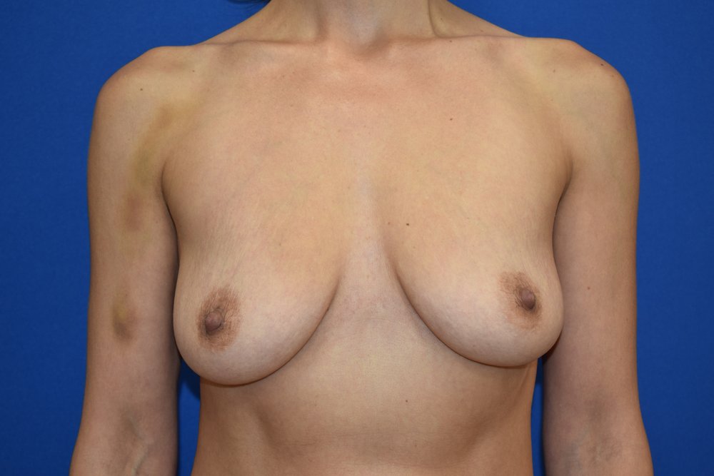 Breast Augmentation before