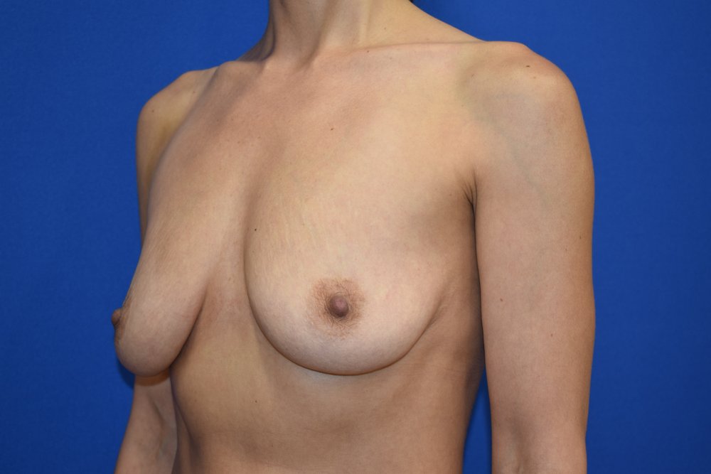 Breast Augmentation before