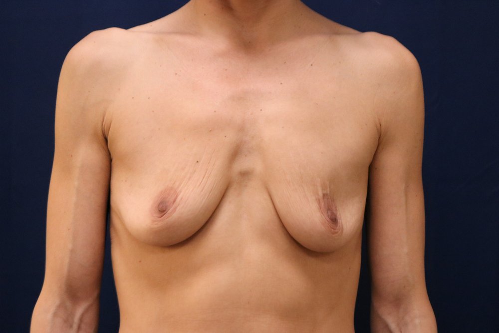 Breast Augmentation before