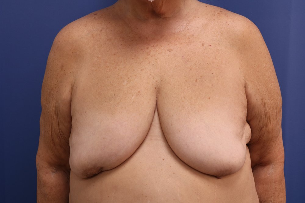 Breast Lift before