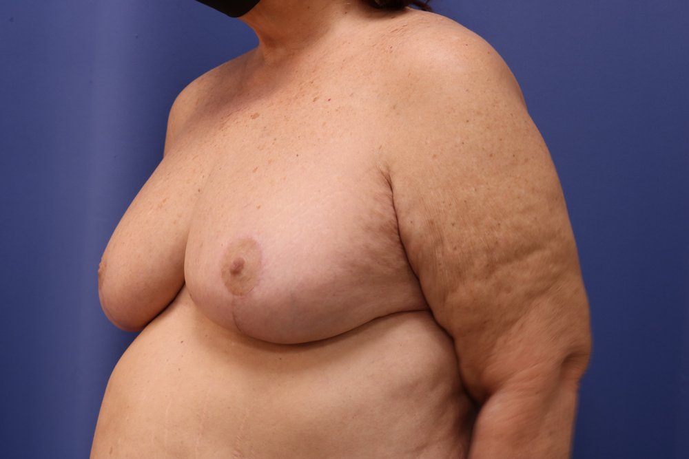 Breast Lift after
