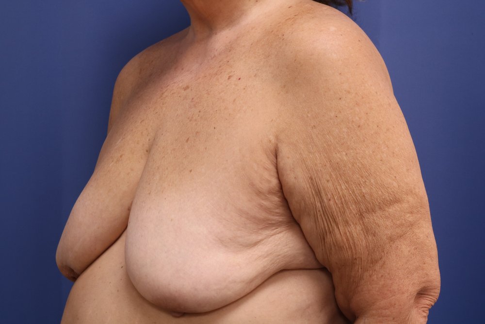 Breast Lift before