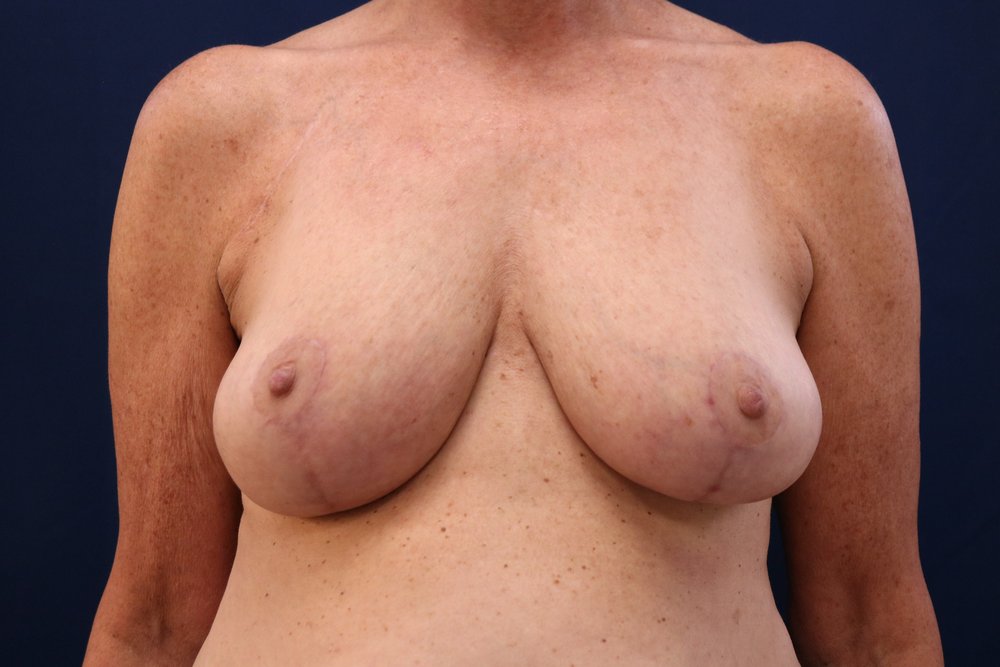 Breast Reduction after