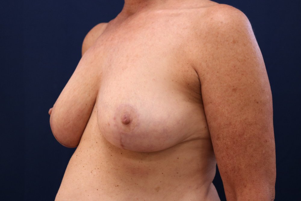 Breast Reduction after