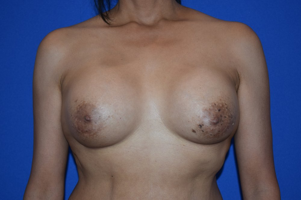 Breast Revision before