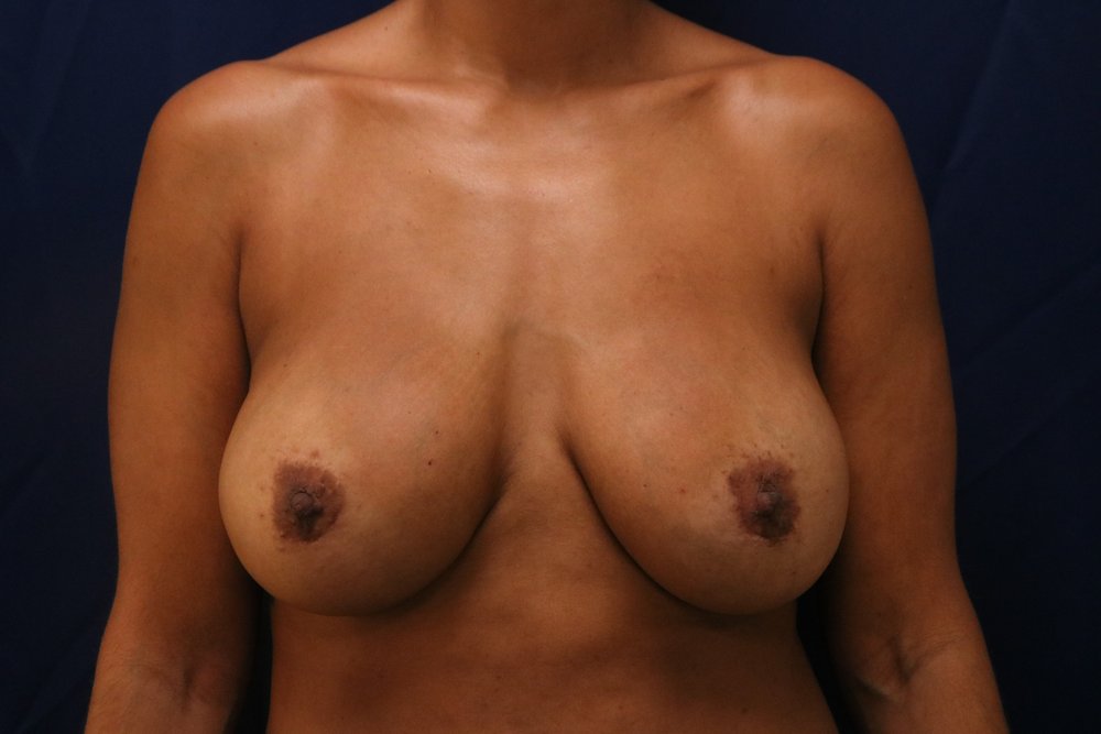 Breast Revision after