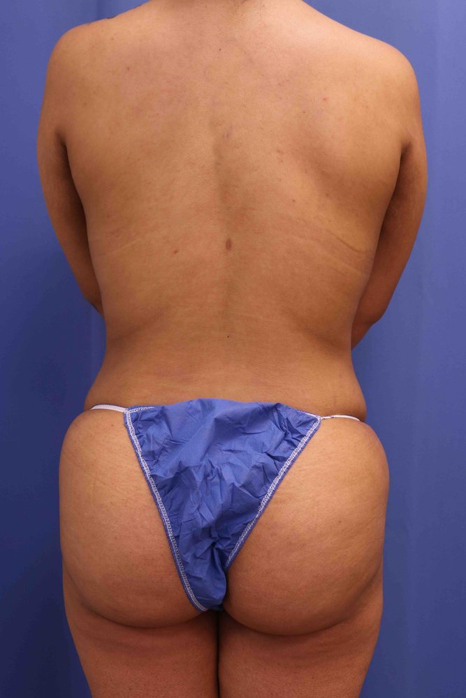 Butt Augmentation (BBL) after
