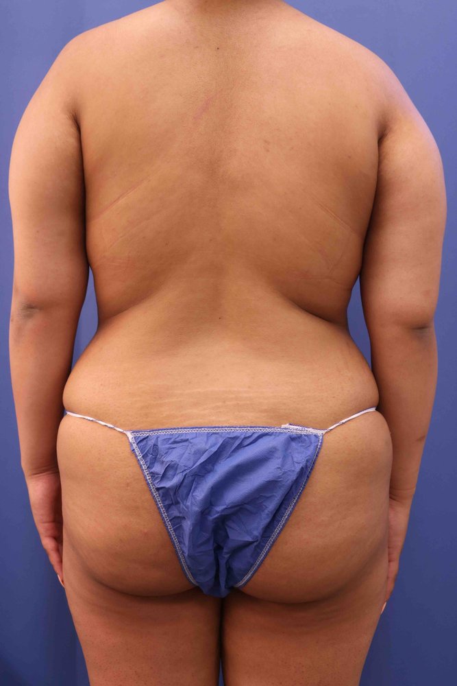 Butt Augmentation (BBL) before