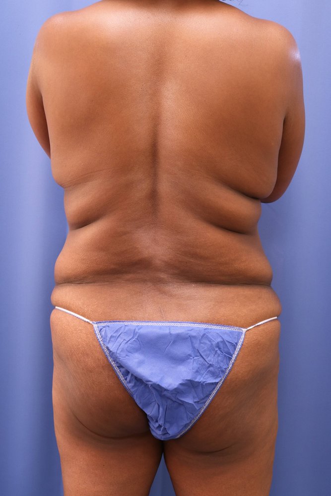 Butt Augmentation (BBL) before