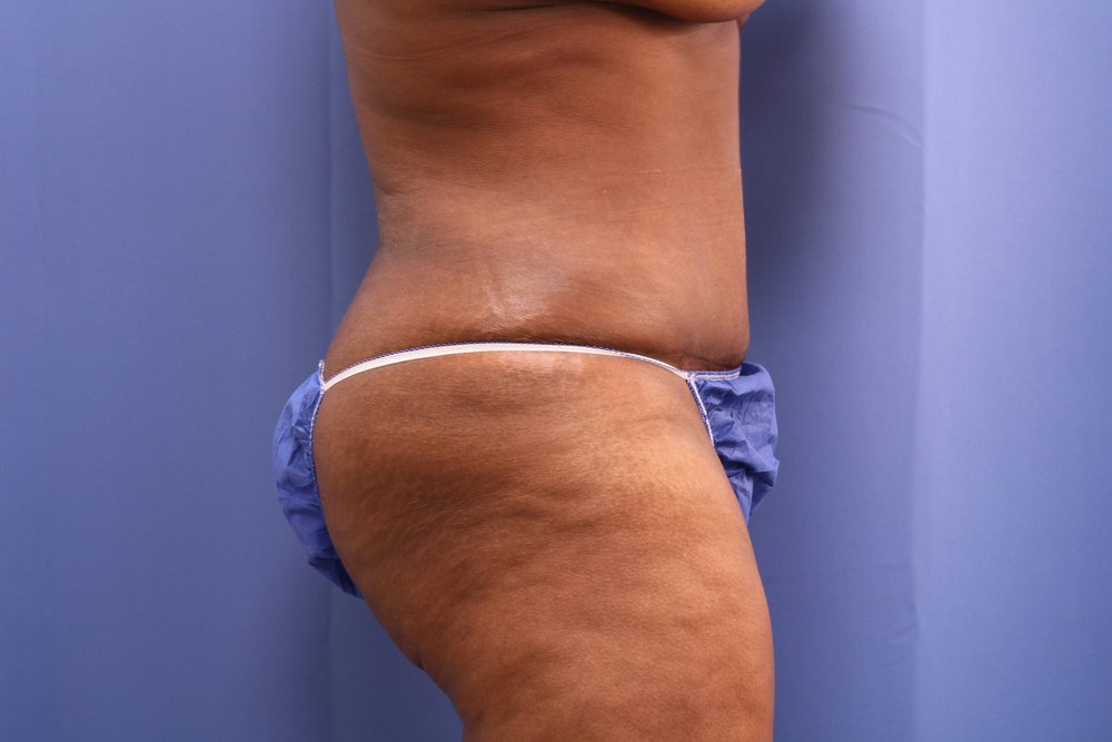 Butt Augmentation (BBL) after