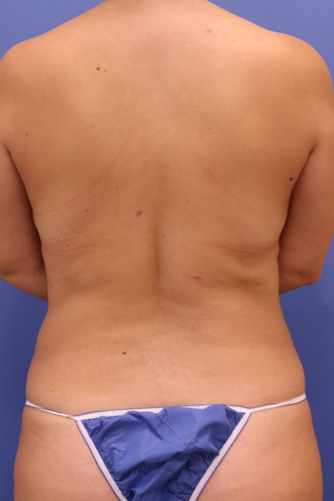 Liposuction after
