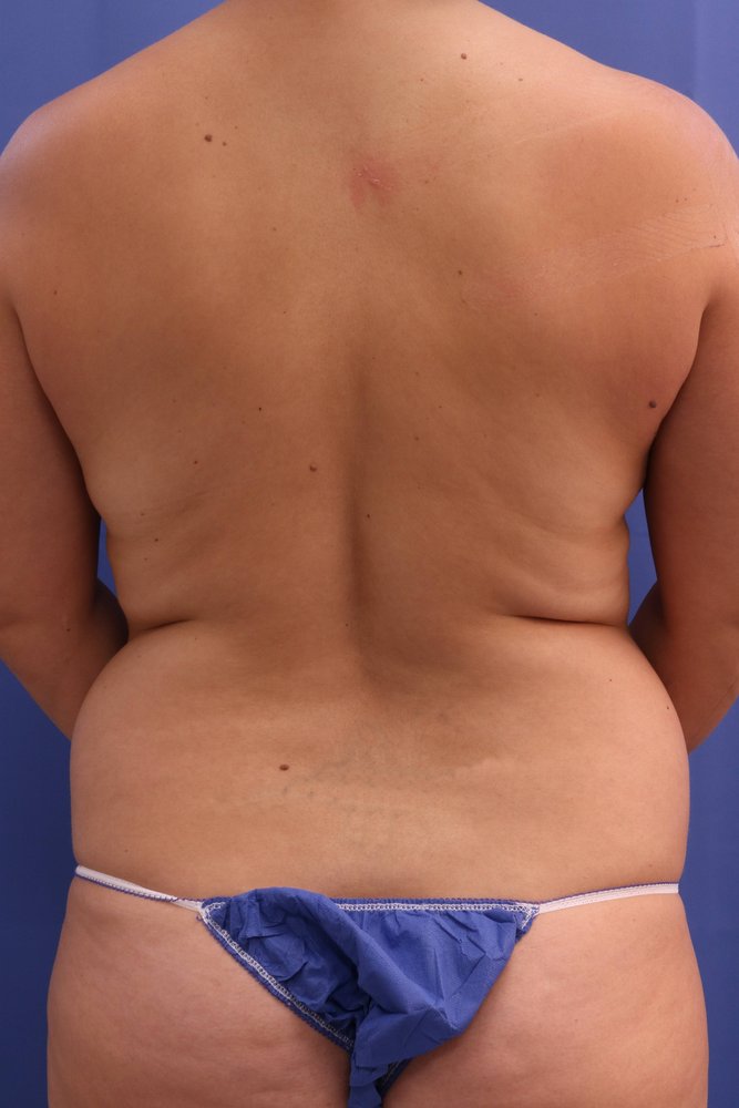 Liposuction before