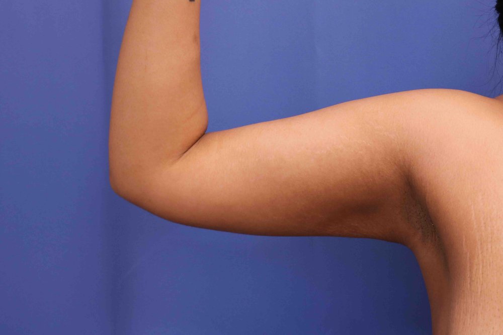 Liposuction after