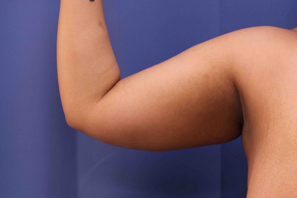Liposuction before