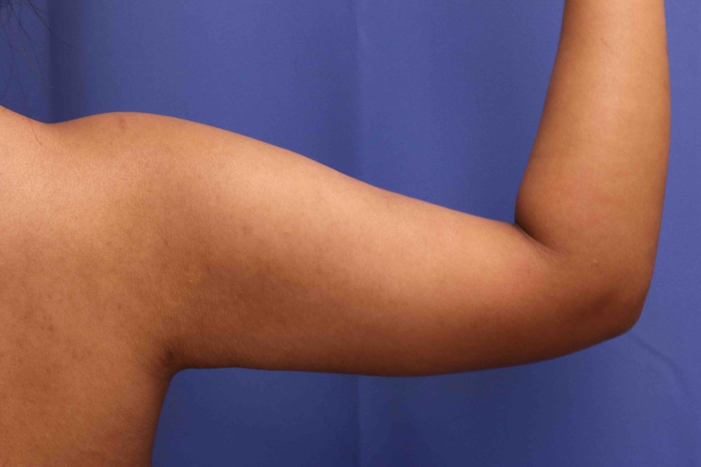 Liposuction after