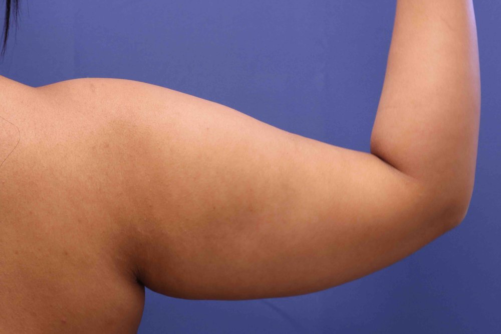 Liposuction before