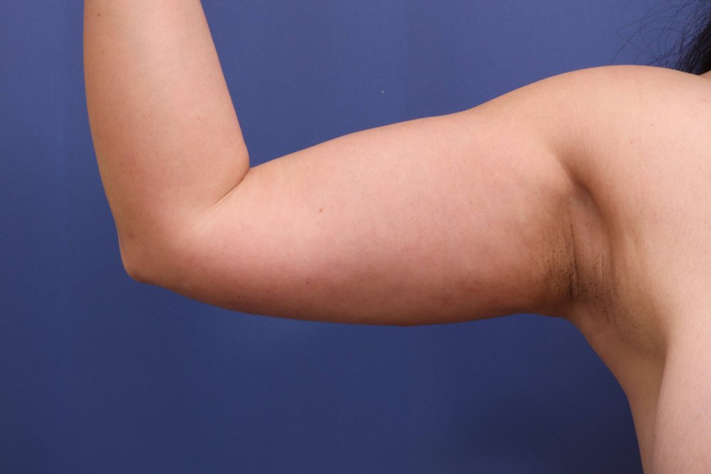 Liposuction after