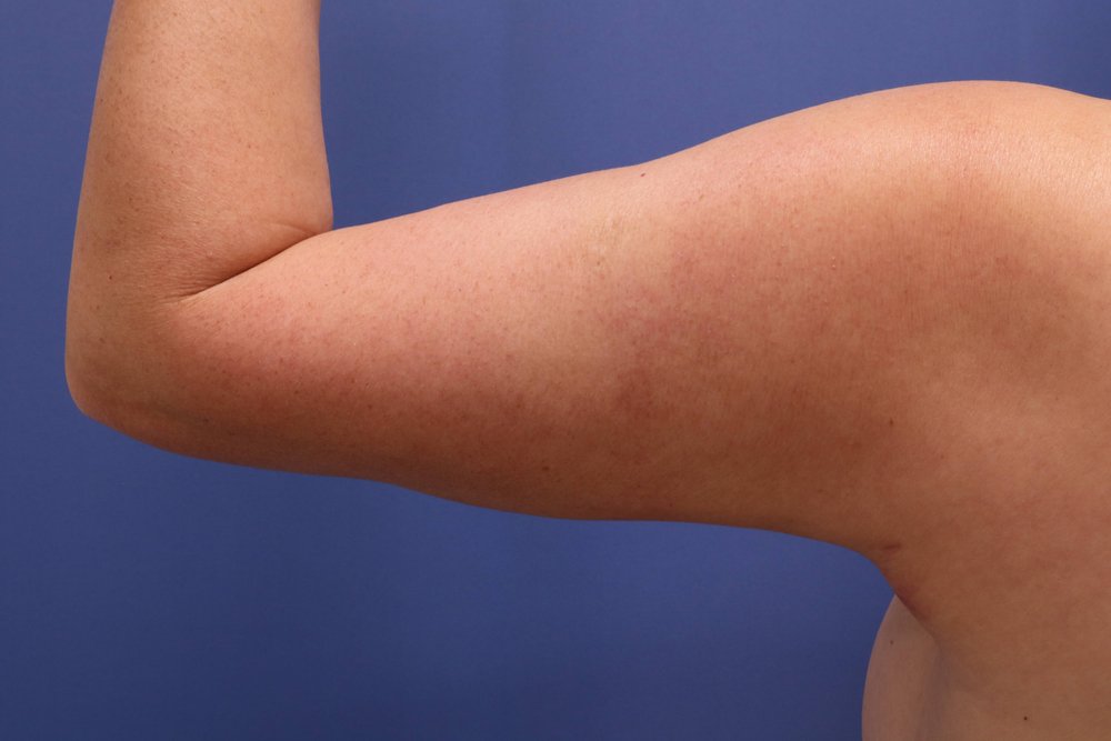 Liposuction after