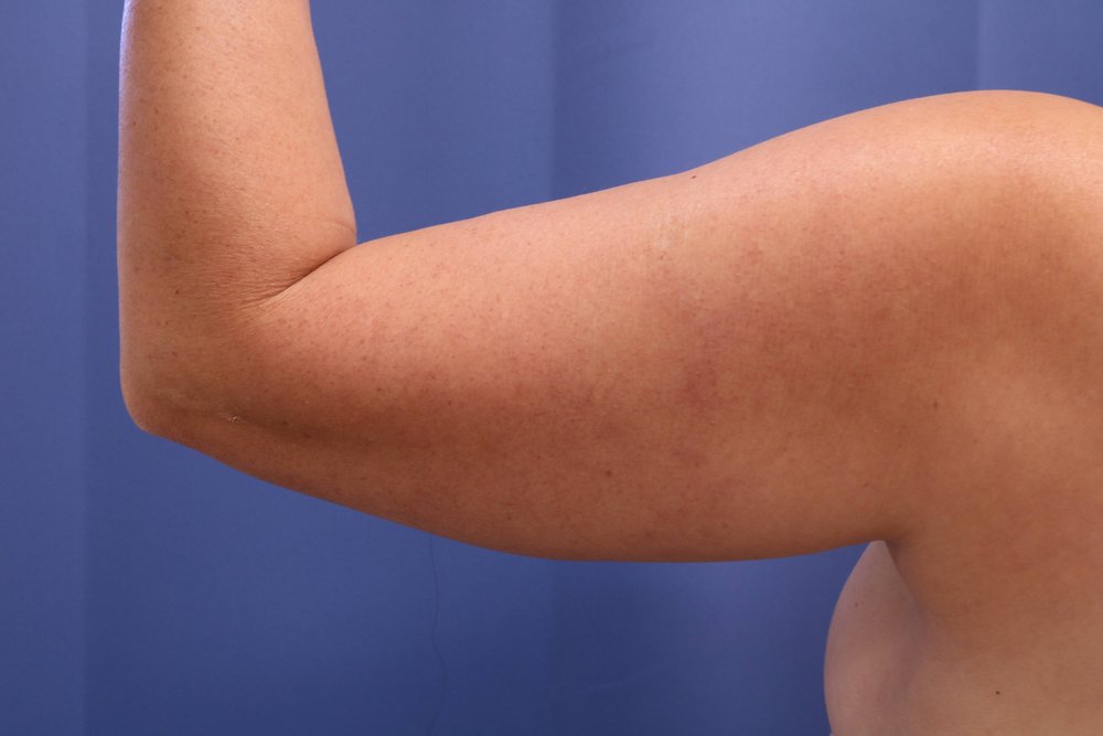 Liposuction before