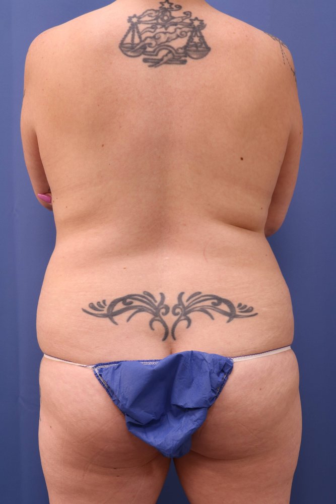 Liposuction before