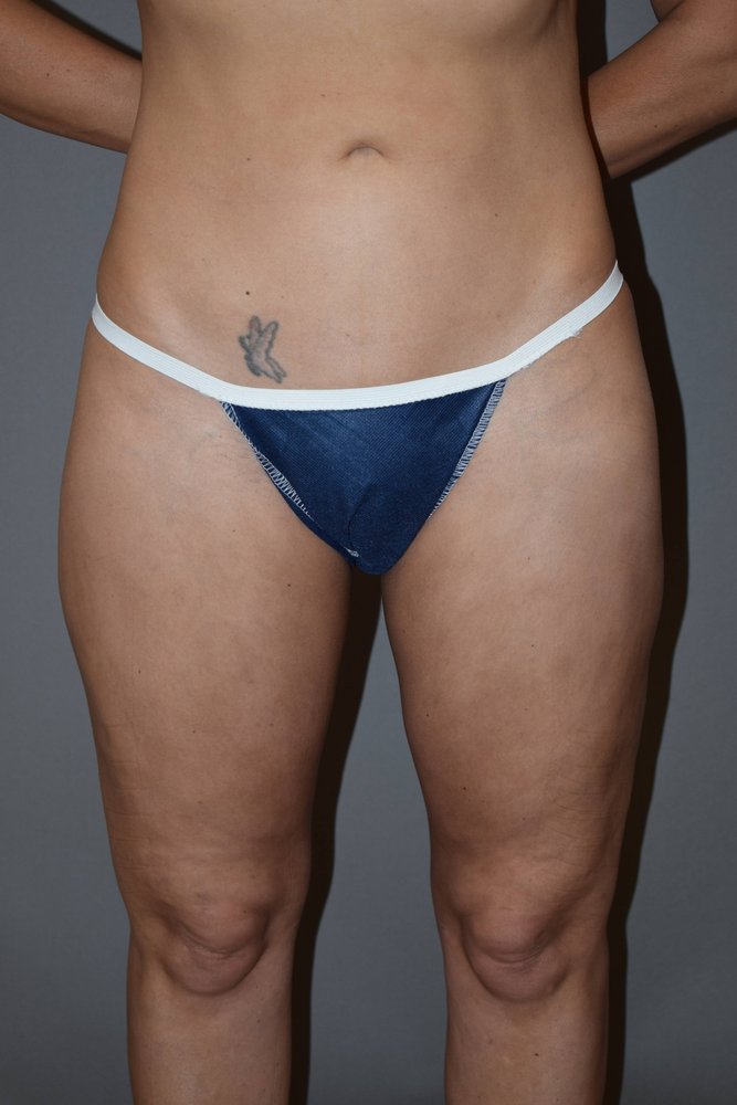 Liposuction after