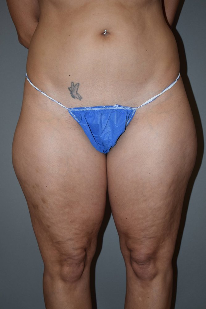 Liposuction before