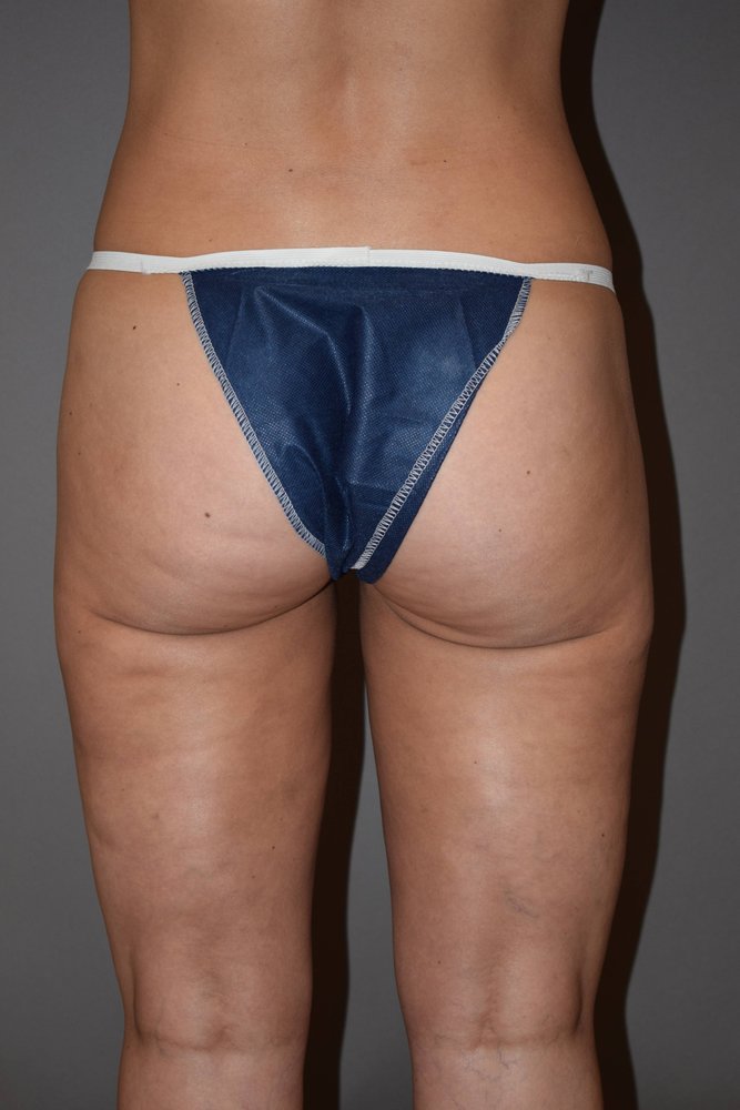 Liposuction after