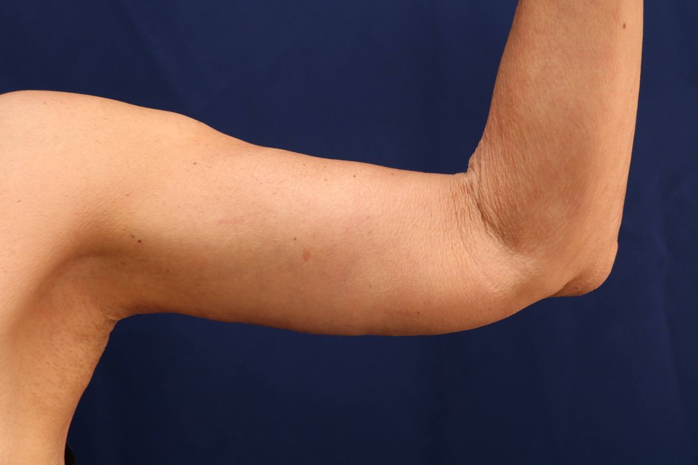 Arm Lift after
