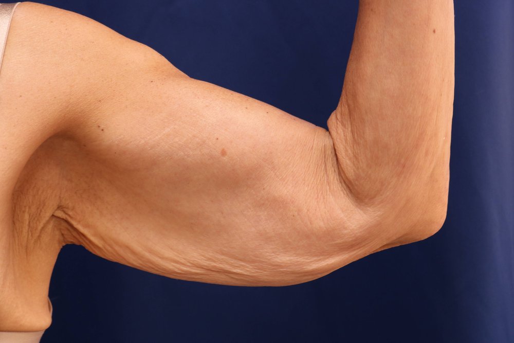 Arm Lift before