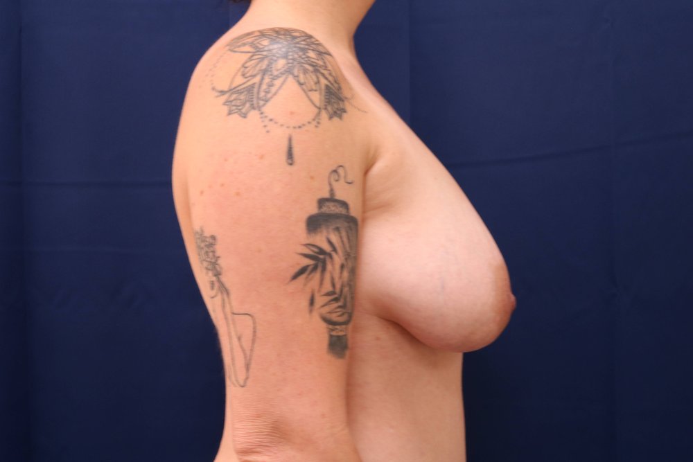 Forever Breast® Natural Augmentation after
