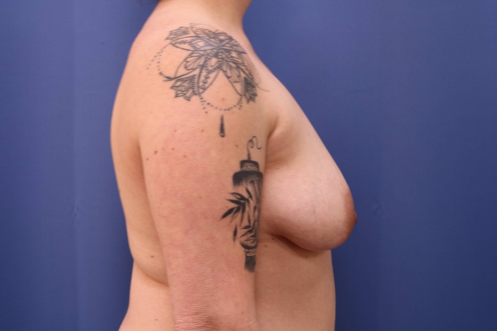 Forever Breast® Natural Augmentation before
