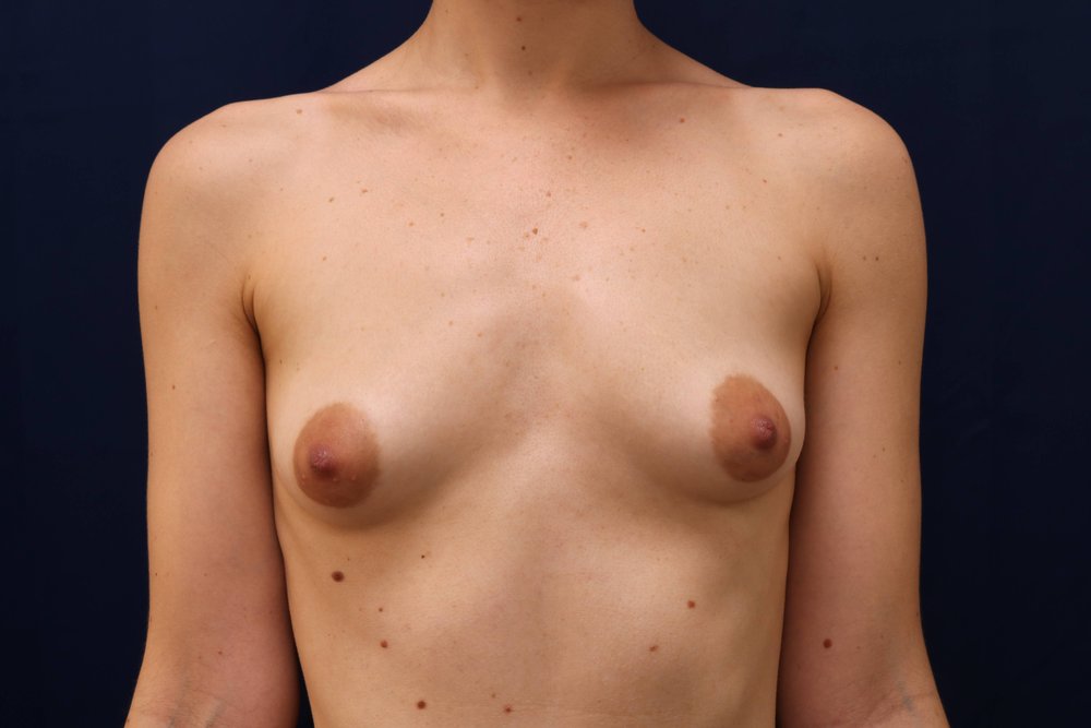 Forever Breast® Natural Augmentation before