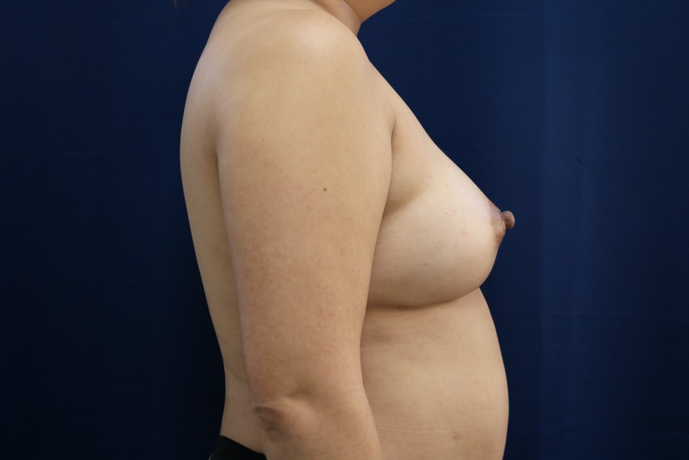 Forever Breast® Natural Augmentation after