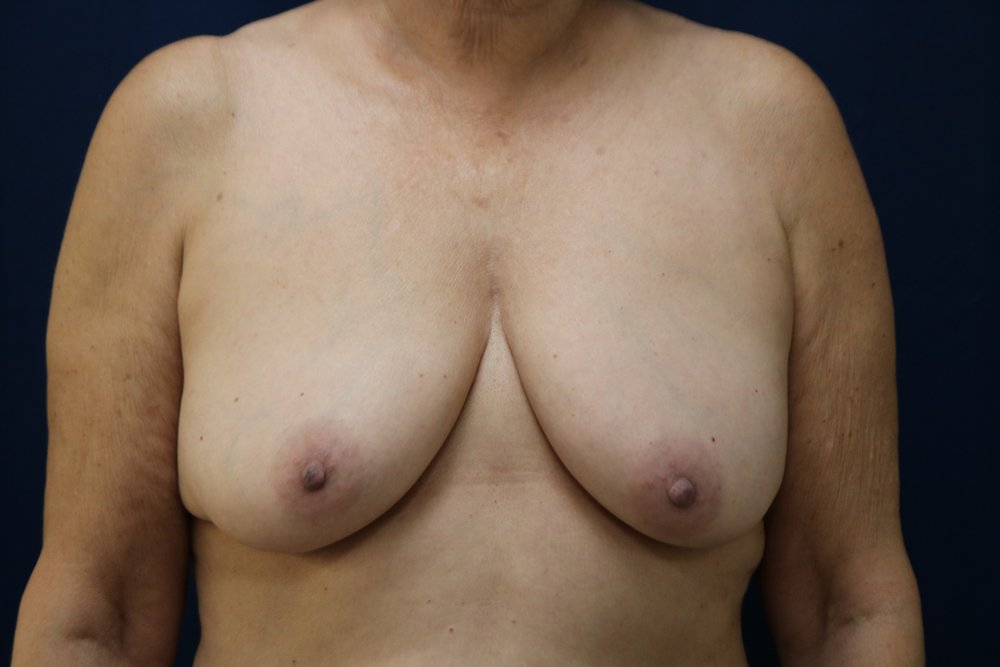 Forever Breast® Natural Augmentation before