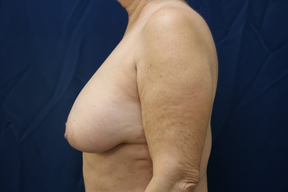 Forever Breast® Natural Augmentation after